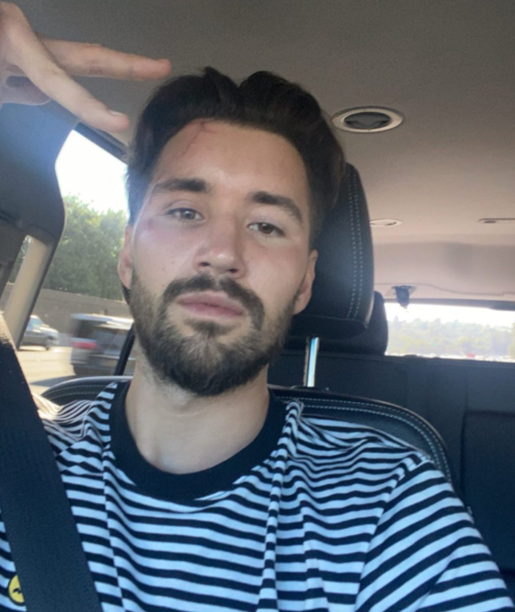 ANOTHAWiLDLOGAN's tweet photo. no more stitches 😎 https://t.co/IAVJzNZMF8