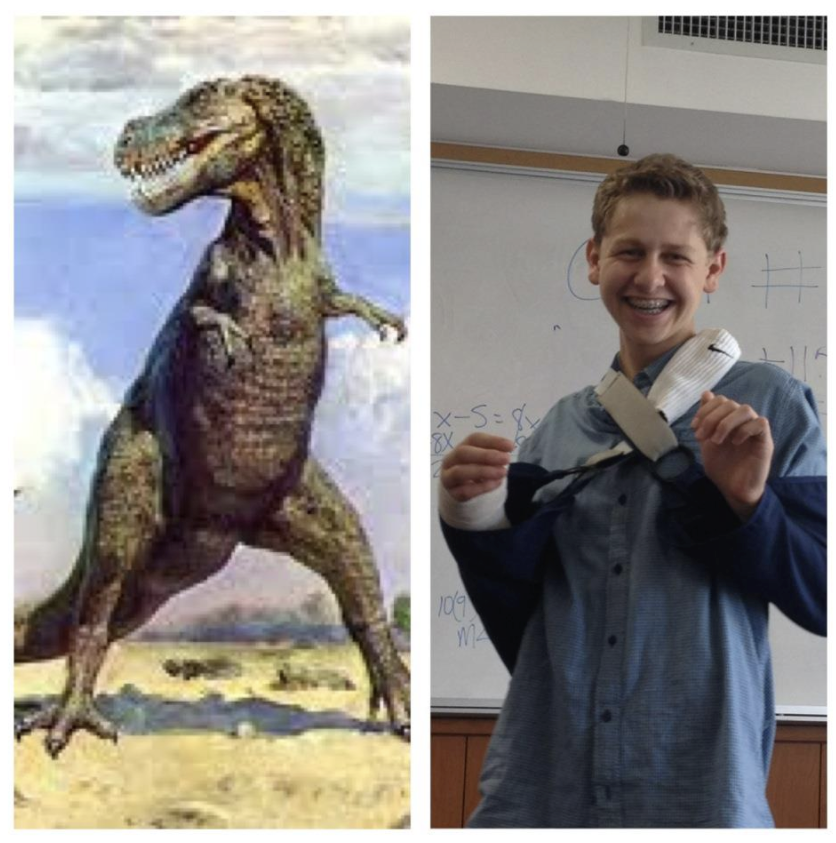 The first week sucked, 2 slings & many doctor appointments, pain killers + sleep trouble, the normal discomfort for broken bonesMy wrist was so displaced it took 2 hours to set in the emergency room, that suckedHere are some photos I could find