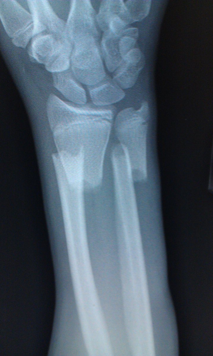 The first week sucked, 2 slings & many doctor appointments, pain killers + sleep trouble, the normal discomfort for broken bonesMy wrist was so displaced it took 2 hours to set in the emergency room, that suckedHere are some photos I could find