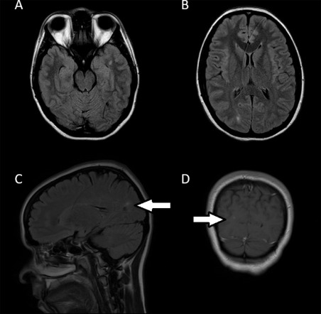 Can Covid-19 cause MS?  This is a case report of a 29 year old woman who recently contracted COVID-19 and then developed optic neuritis and was subsequently found to have [a small number of] demyelinating brain lesions.  CSF +.  anti-AQP4/MOG negative. sciencedirect.com/science/articl…