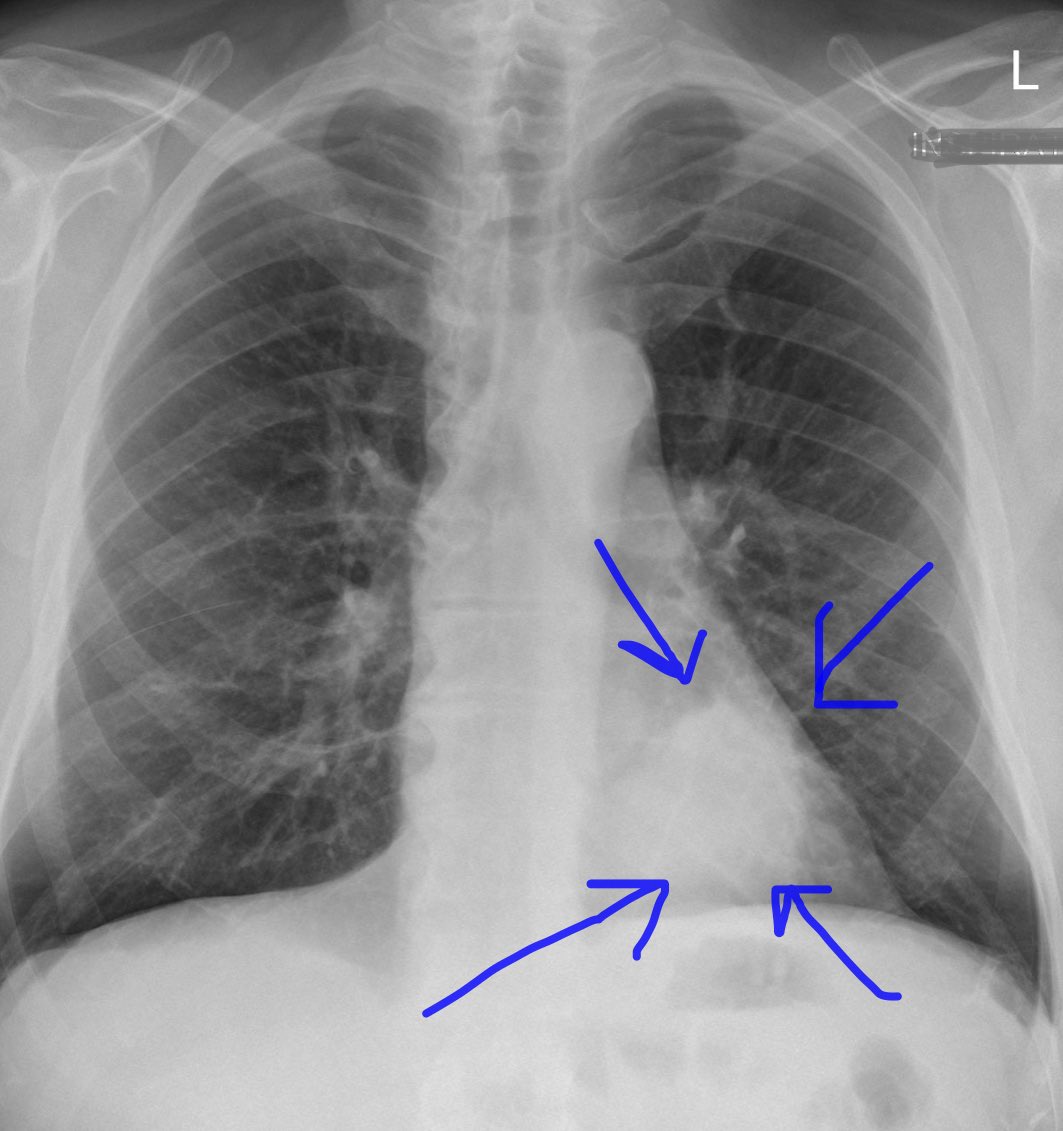 Learn From BHRUT Radiology every day & on the go! Don’t forget to look behind the heart to avoid missing significant retrocardiac masses on a CXR. Check your review areas! @Ifeakiny learn from discrepancies @amanthesurgeon @sasbanerjee @Lapsurgery  #radiology #chestxray