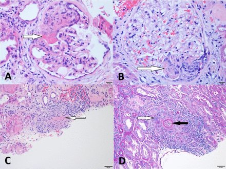 jitcancer's tweet image. New #JITC article: Checkpoint inhibitor-related renal vasculitis and use of rituximab ow.ly/SGoK50AG7zC