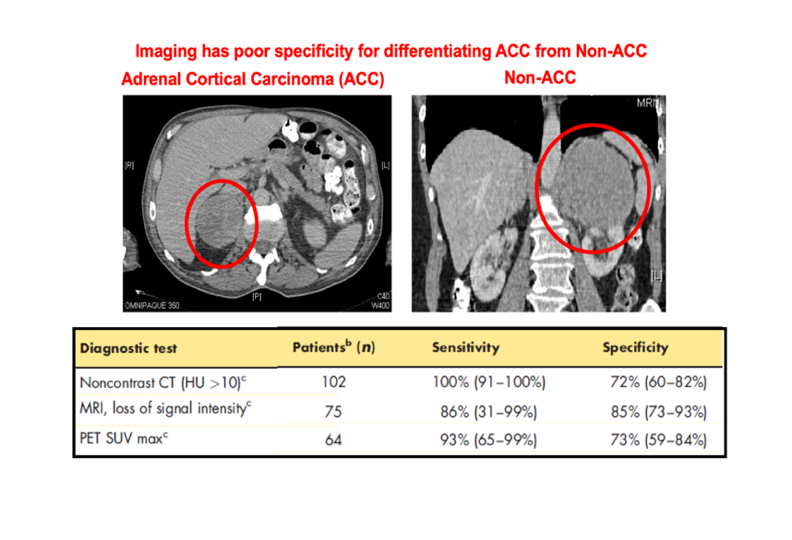 #2 Cross-sectional imaging by CT or MRI regularly discovers adrenal masses; 2-12% are eventually diagnosed as adrenal cortical carcinoma  #ACC . However, limited specificity of imaging prevents accurate detection of  #ACC  https://eje.bioscientifica.com/view/journals/eje/175/2/R51.xml