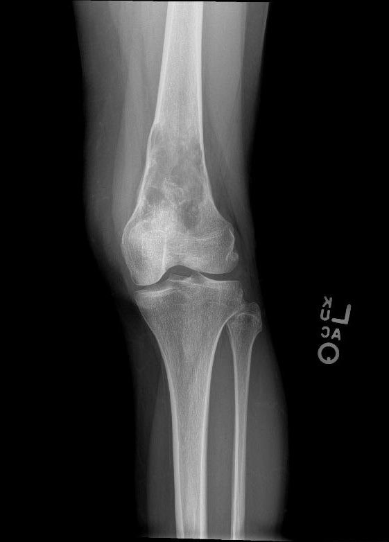 twins1120's tweet photo. 52-year-old female with left knee pain for months. Imaging showed a aggressive metadiaphyseal lesion with cortical thinning and breakthrough. What is the best diagnosis? #BSTpathology #boneandsofttissue #pathology #boneandsofttissuepathology https://t.co/ZMu0ZR2n2Y