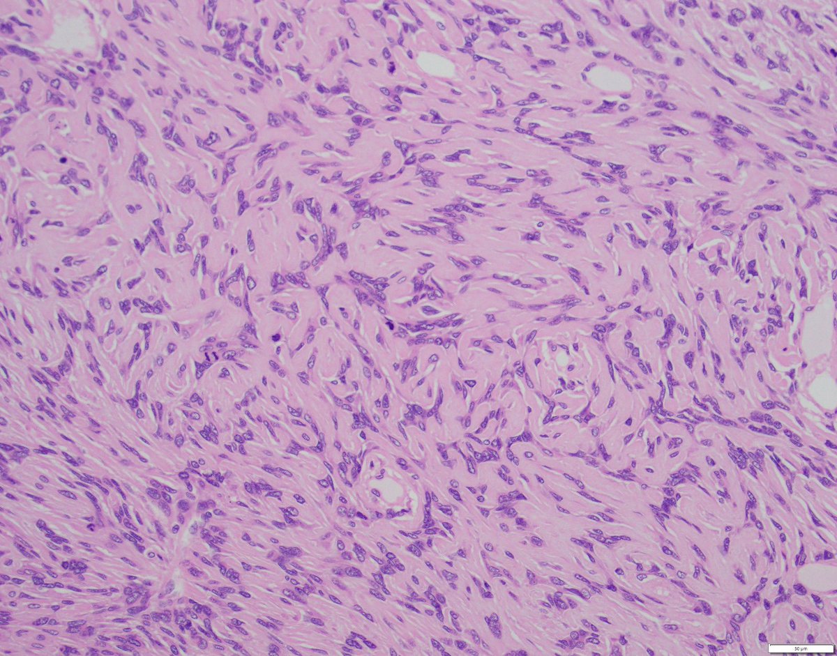 twins1120's tweet photo. 52-year-old female with left knee pain for months. Imaging showed a aggressive metadiaphyseal lesion with cortical thinning and breakthrough. What is the best diagnosis? #BSTpathology #boneandsofttissue #pathology #boneandsofttissuepathology https://t.co/ZMu0ZR2n2Y