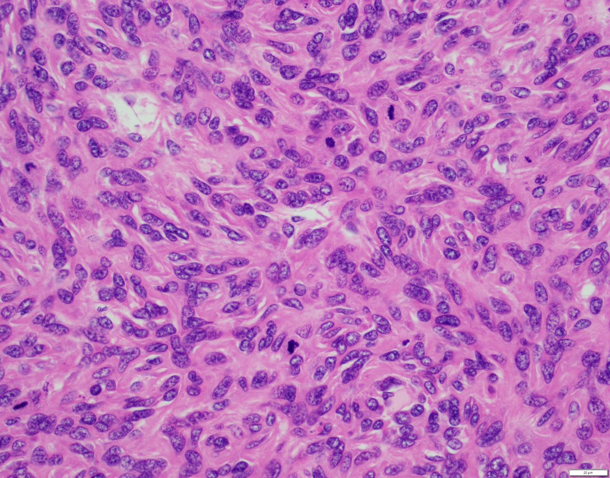 twins1120's tweet photo. 52-year-old female with left knee pain for months. Imaging showed a aggressive metadiaphyseal lesion with cortical thinning and breakthrough. What is the best diagnosis? #BSTpathology #boneandsofttissue #pathology #boneandsofttissuepathology https://t.co/ZMu0ZR2n2Y