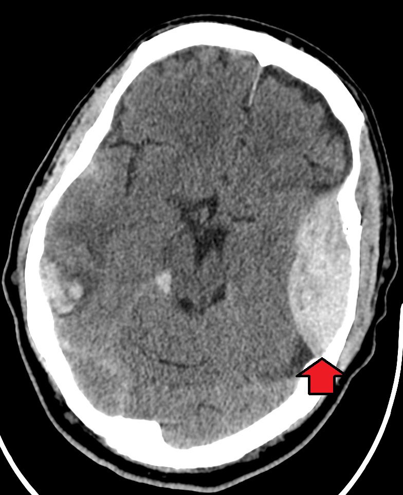1- epidural hemorrhages ( EDH) - Caused by laceration of meningeal arteries ( middle ) - Sometimes Associated with skull fractures ( temporal bone ) - Lenticular ( biconvex ) hematomas on CT scan.