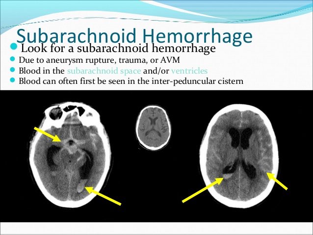 3- Subaracnoid hemorrhage ( SAH ) - Caused by ruptured aneurysm, arteriovenous malformation, direct injury to the pia vessels or extention from intraventricular hemorrhage. - Nausa and vomiting, confusion or obtundation.