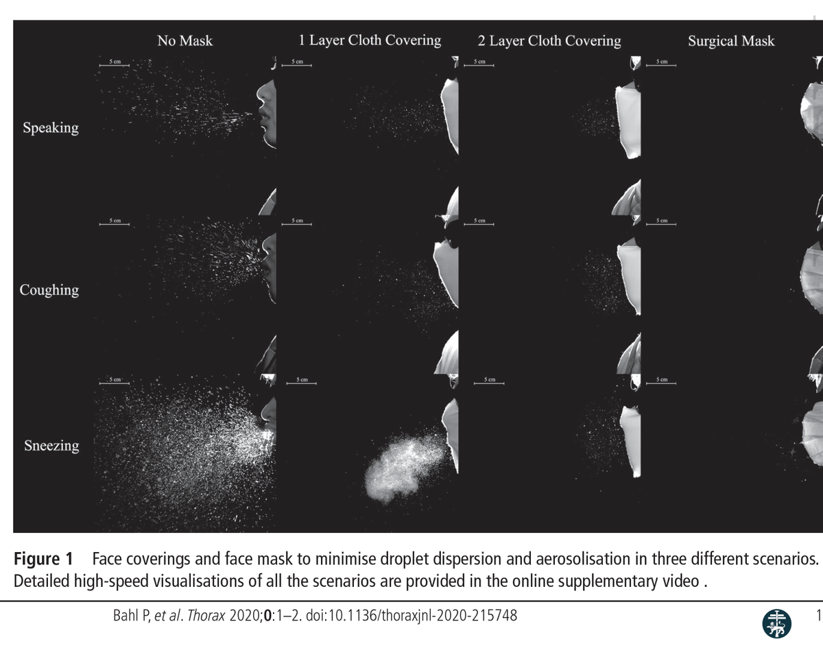 EricTopol's tweet photo. For cloth masks, 2 layers (3 even better) needed to reduce dispersal of airborne viral droplets
New @ThoraxBMJ video study shows the difference
https://t.co/gI4YPROoMH https://t.co/oGqnhHypSY
