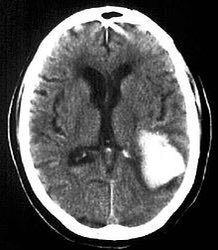 4- intraparenchymal hemorrhage - caused by laceration of cortical parenchyma due to Contusion (coup or countercoup)- patient may have loss of consciousness and seizures - depends on anatomical location
