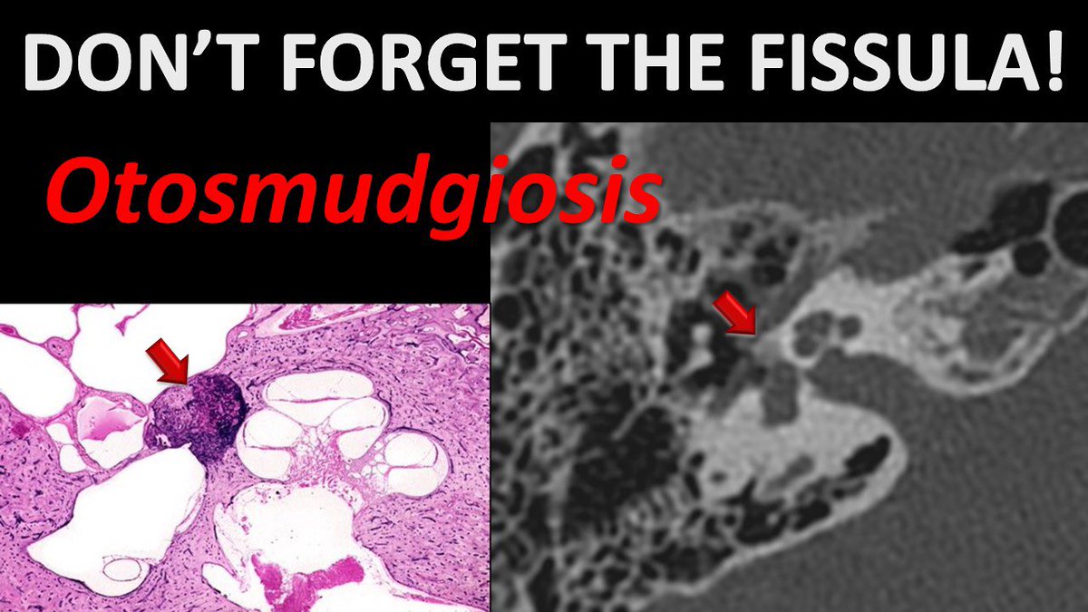 CMGlastonbury's tweet photo. #OTOSMUDGIOSIS! Was just reviewing a tbone case with a fellow and that’s what he called it. And just like that, we have a new, improved name for this entity!! https://t.co/Fsmt5HQkmh
