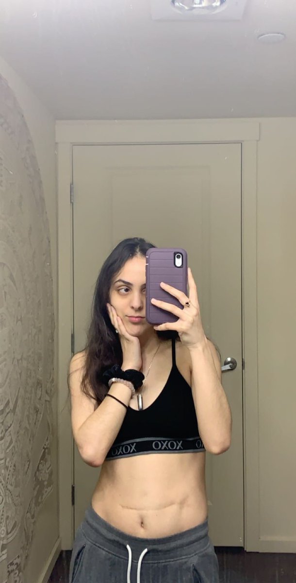 reynacamarena_'s tweet photo. growing up with lots of surgery scars was hard but i’ve learned to love them. i saw myself as imperfect & was so self conscious of how others would see me and now, i realize that i was born a fighter & no one is going to belittle me for my fight for life. #MyBodyIsBeautiful https://t.co/iqyuvrHUPr