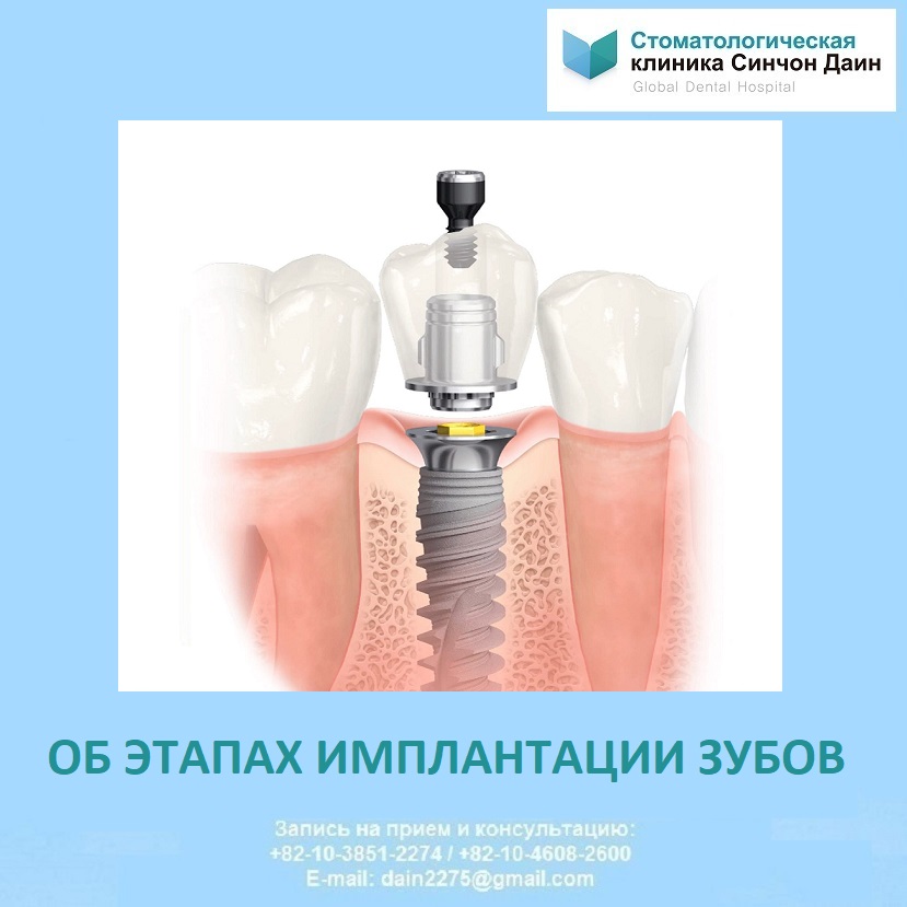 MariaDain's tweet photo. 1ый этап консультация врача,рентген-диагностика.Врач определит,подходит ли процедура в вашем случае,подберет нужный имплантат.Если собственных тканей для установки имплантата не хватает,предложат проц-ру увеличеня объема–костная пластику десны.Затем запишут на установку https://t.co/yQujxotNnP