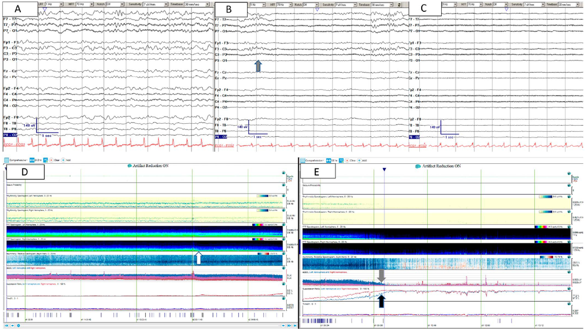 DrAatifHusain's tweet photo. What are the EEG correlates of increased ICP? Paper by @MonicaDhakar and others in @JClinNeurophys shows rhythmic delta and loss of faster frequencies occurs with increased ICP, hours before clinical changes. https://t.co/QDJVmDFM7a @ACNS_org @Duke_Neurology #DukeEpilepsy https://t.co/YTK77dWugg