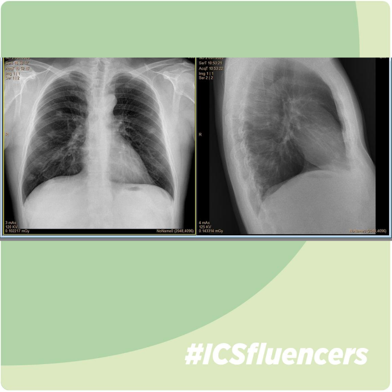 icscat's tweet photo. @purirobles2 #ICSfluencers @purirobles2: “De tots els casos de #COVID19 diagnosticats només hem hagut de demanar 3 radiografies i només una presentava infiltrats bilaterals.  ”#S54PR #apcostaponent https://t.co/IcNfGYTOdN