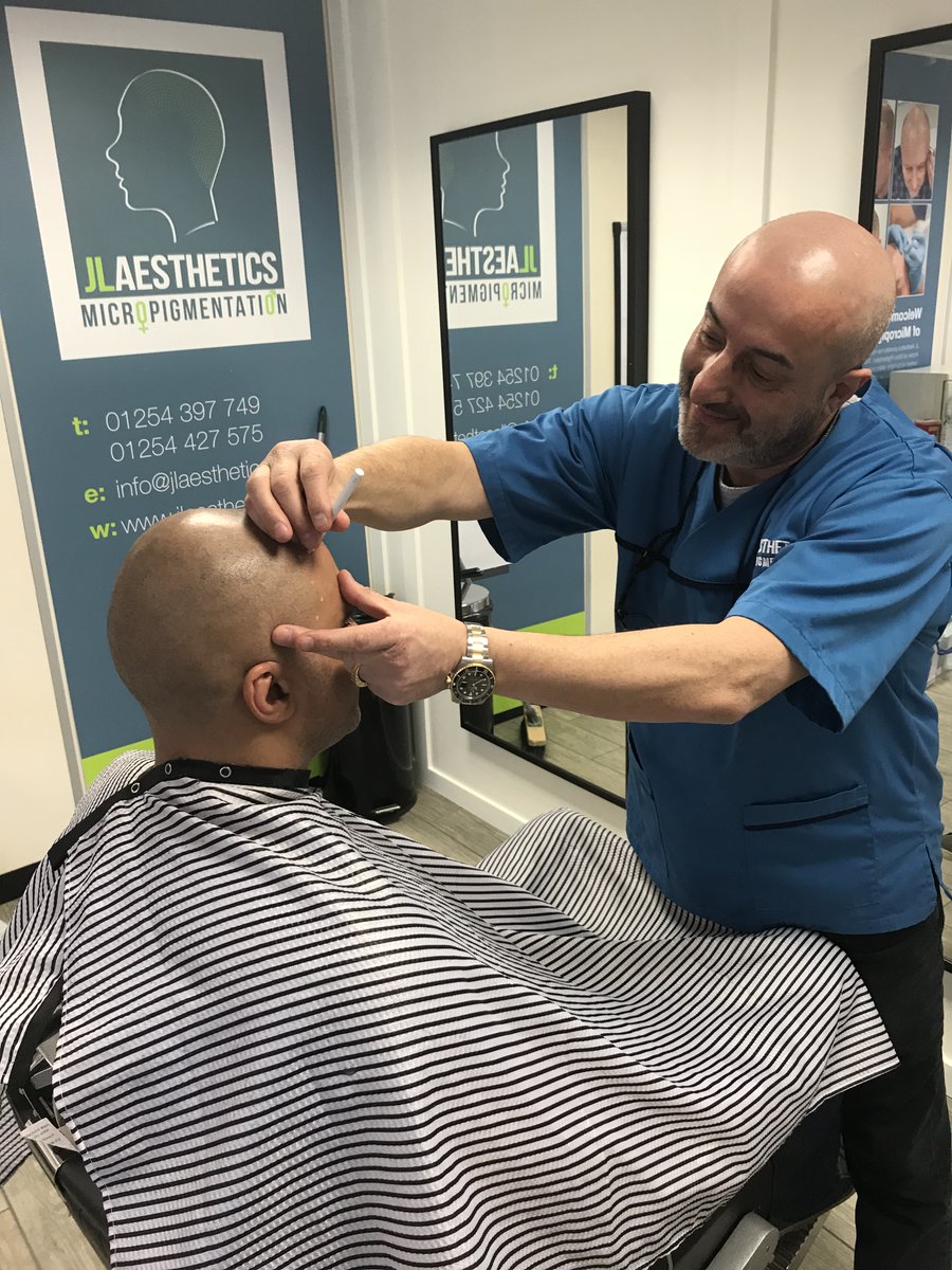 #scalpmicropigmentation is a non-invasive and natural-looking treatment for hair loss.