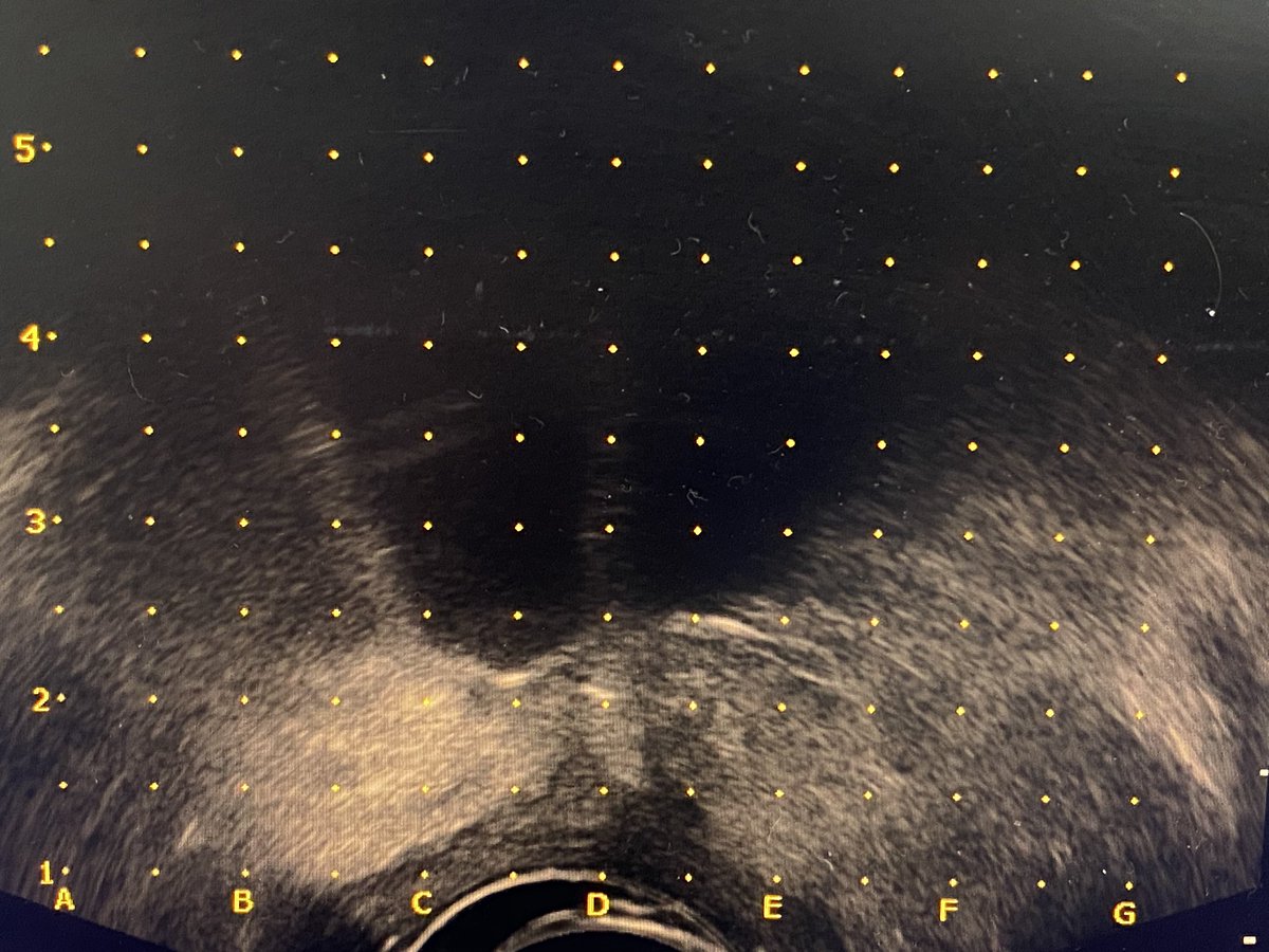 Mateusz MokrzyĹ› (@mmokrzys) on Twitter photo Second day of Focal #ProstateCancer #CryoTherapy - demanding, but perfectly feasible posterior lesion cases.
Dr Ulrich Witzsch, <a href="/mzawadzk1/">Marek Zawadzki</a>, <a href="/PrzemyslawZugaj/">Przemysław Zugaj</a>
Special thanks to <a href="/bostonsci/">Boston Scientific</a> <a href="/KoelisBx/">KOELIS</a> <a href="/MedenInmed/">Meden-Inmed</a> <a href="/ExactImaging/">Exact Imaging</a>
#FocalTherapy #krioablacja #Piaseczno #TRexit Second day of Focal #ProstateCancer #CryoTherapy - demanding, but perfectly feasible posterior lesion cases.
Dr Ulrich Witzsch, <a href="/mzawadzk1/">Marek Zawadzki</a>, <a href="/PrzemyslawZugaj/">Przemysław Zugaj</a>
Special thanks to <a href="/bostonsci/">Boston Scientific</a> <a href="/KoelisBx/">KOELIS</a> <a href="/MedenInmed/">Meden-Inmed</a> <a href="/ExactImaging/">Exact Imaging</a>
#FocalTherapy #krioablacja #Piaseczno #TRexit