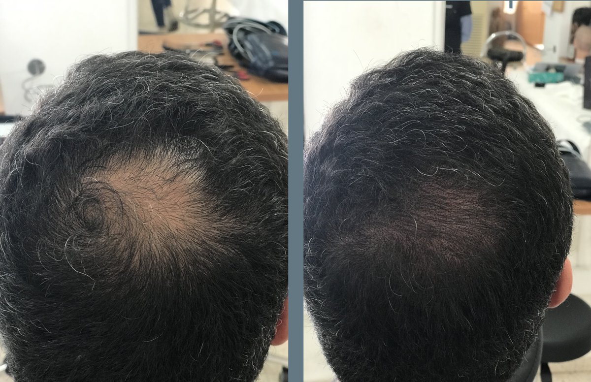 Restore your confidence and finally forget about your hair loss! #scalpmicropigmentation replicates the natural hair follicles, giving you the appearance of a full head of hair.