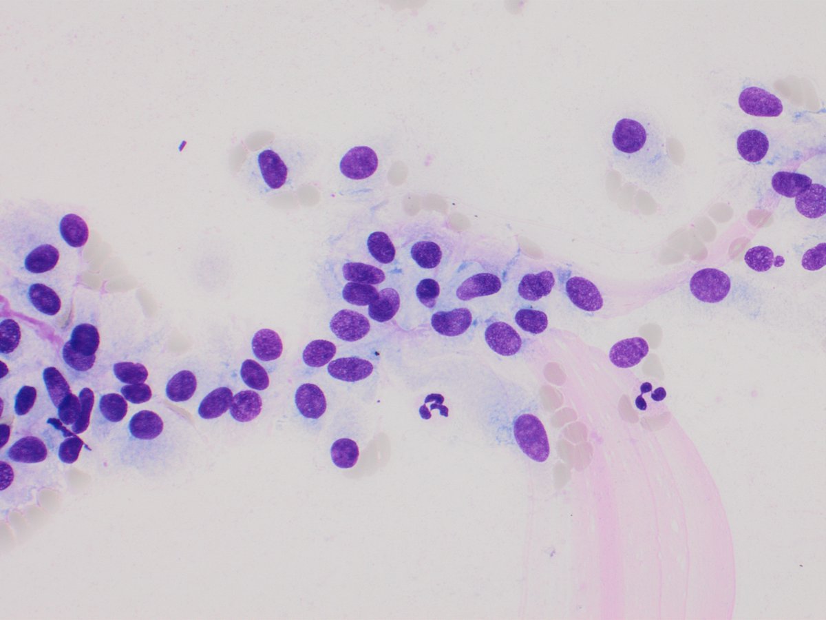 gildasantoscyto's tweet photo. Thyroid #FNA for #FNAFriday to illustrate the stippled chromatin and the spindle shaped nuclei in a "school of fish" pattern. @Sara_Jiang @DrBMcGinn @sza_jhcyto @MauroSaieg @PhilippeCytoMD @mdlozanoe @DianaEstherossi #pathology #PAAF #citologia https://t.co/TDwkrHDsla