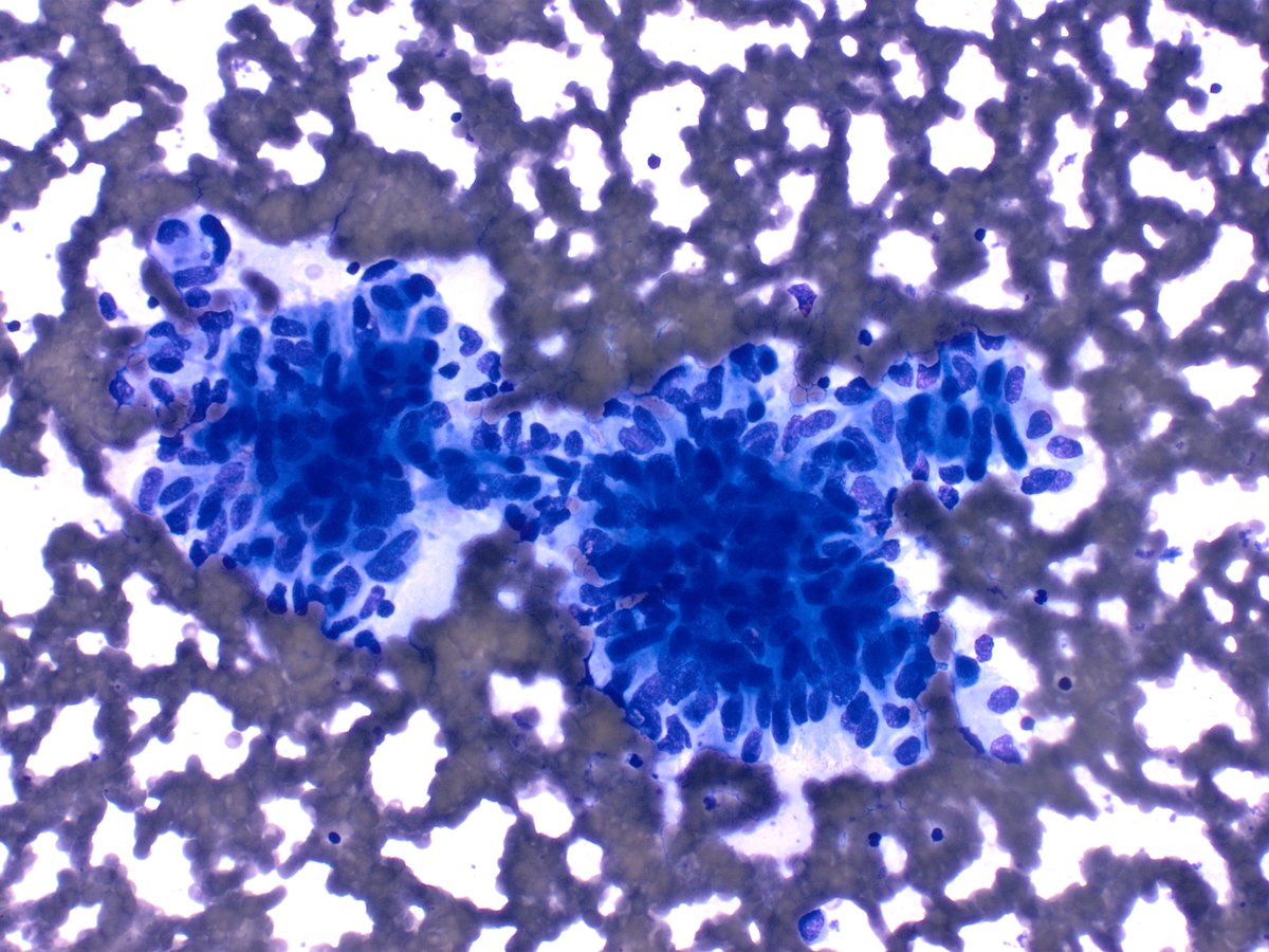 gildasantoscyto's tweet photo. Thyroid #FNA for #FNAFriday to illustrate the stippled chromatin and the spindle shaped nuclei in a "school of fish" pattern. @Sara_Jiang @DrBMcGinn @sza_jhcyto @MauroSaieg @PhilippeCytoMD @mdlozanoe @DianaEstherossi #pathology #PAAF #citologia https://t.co/TDwkrHDsla