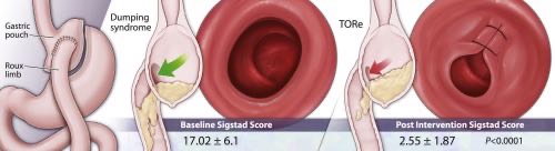 Endoscopic management of dumping syndrome after Roux-en-Y gastric bypass: a large international series and proposed management strategy published in <a href="/GIE_Journal/">GIE</a> by <a href="/EricJVargasMD/">Eric J. Vargas M.D. M.S. ABOM</a> et al. #Obesity

giejournal.org/article/S0016-…