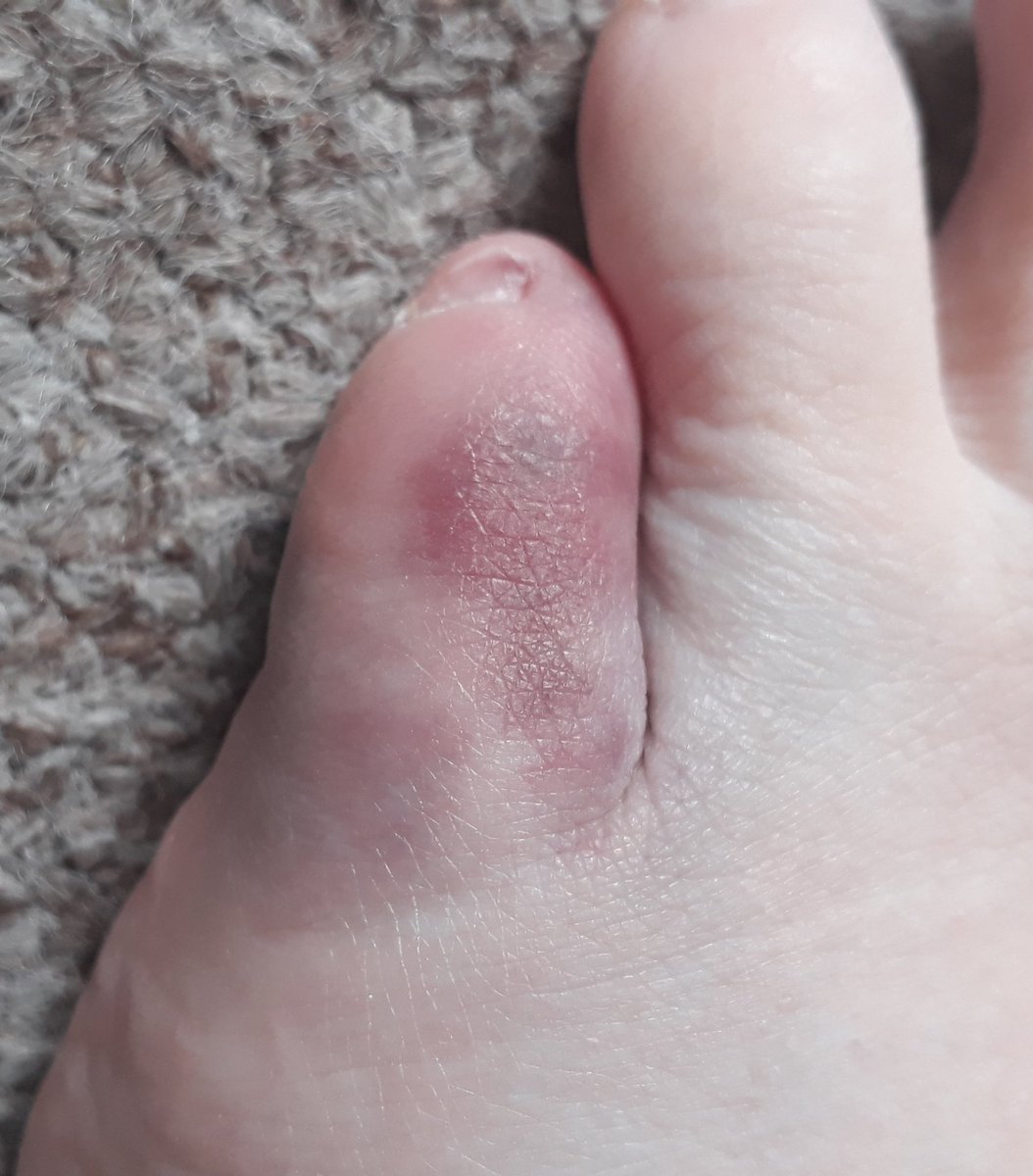 MJ_JJ061215's tweet photo. I kicked the door frame of the loo last night...now my little toe is swollen, bruised and extremely painful. It's really hurts to walk. #ouch #pain #littletoe #bruise #swollen 😭😫🤬👣 https://t.co/dorHgR5Pgk