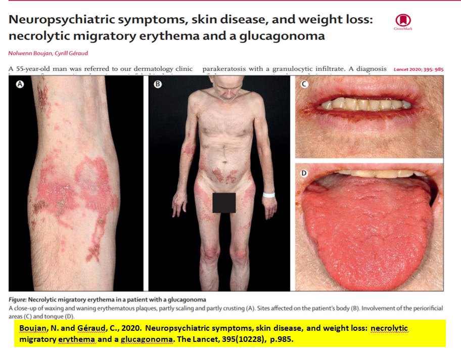 Neuropsychiatric symptoms, Migratory skin rashes , extensive catabolism presenting as weight loss with Uncontrolled diabetes!
Diagnostic workup showed an increase in Fasting Gastrin levels, chromogranin A.CT scan showed a pancreatic mass.
Dx: Glucagonoma (secondary Diabetes)