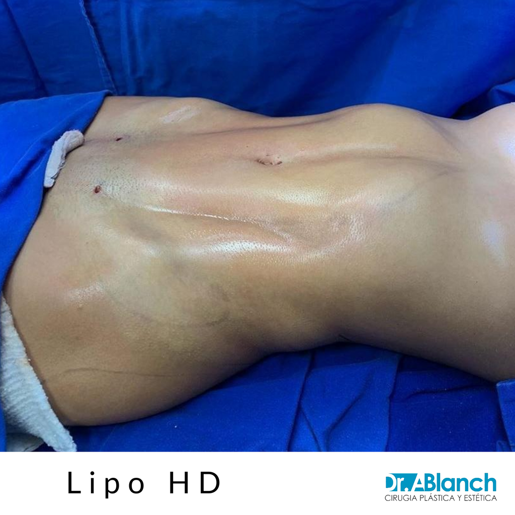 DrBlanch's tweet photo. 🔥LIPO HD ✅ Resultado recién terminada de una LIPO DE ALTA DEFINICIÓN en la que se marca los músculos oblicuos y el abdomen.
😀¡Feliz fin de semana a tod@s!
#liposuccion #liposuction #lipo #lipohd #abdomen #oblicuos #cirujano #cirujanoplastico #cirugia #cirugiaestetica https://t.co/h8TBKUzmEY