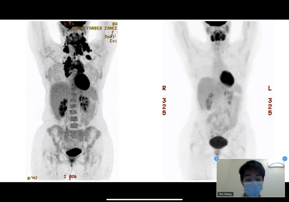 Yale Hematology Oncology Fellows tweet media