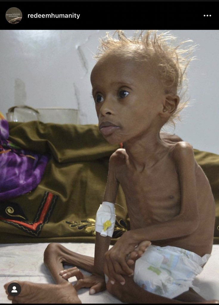 nernerhkay's tweet photo. Yemen canโt breathe!
Check out my previous tweet for better understanding
https://t.co/puDf0eoh8H
#redeemhumanity #SaveYemen #YemenCantBreathe #YemenCrisis #YemeniLivesMatter @redeemhumanity
#help #Yemen https://t.co/anbFWUwyg4