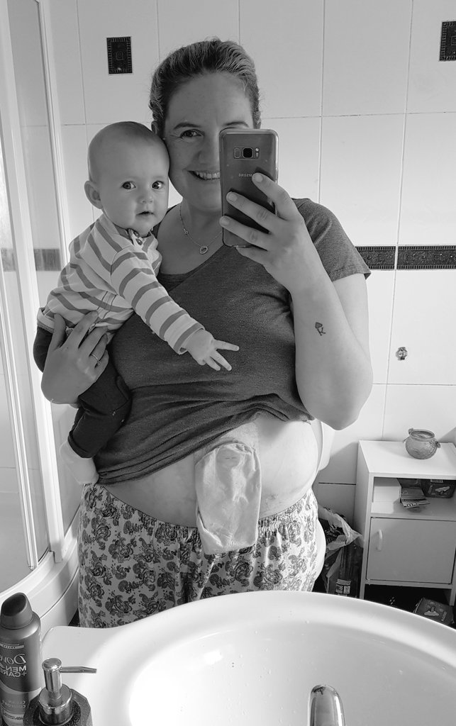 DonamiciMonster's tweet photo. Ok so post baby/lockdown hasn't been kind to the waistline (nothing whatsoever to do with my newfound baking skills, at all). I'm publicly shaming myself into kicking this large arse into shape. TBC.....
#stoma #gladragsandshitbags #bagsandbabies #surgerywarrior #uc #ibd #gutless https://t.co/57UdeUFhut