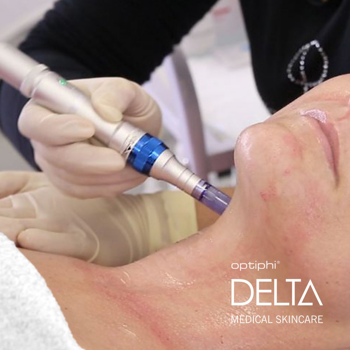 Transform skin by adding micro-needling to professional treatments. Micro-needling treatments work deeper into the dermis, offering remarkable results by increasing production of collagen &amp; elastin,skin firmness, &amp; texture.
#collageninduction #microneedling #antiaging