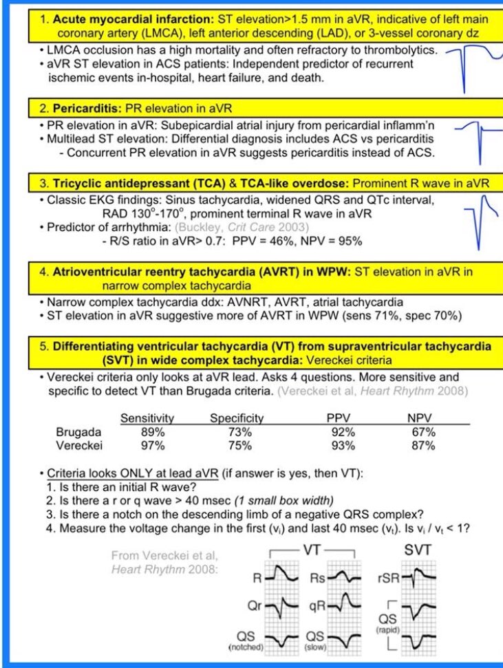 ManualOMedicine's tweet photo. Changes in AVR lead on ECG . #meded #foamed #cardioed #ecg #medtwitter https://t.co/x7QUvjQf2D