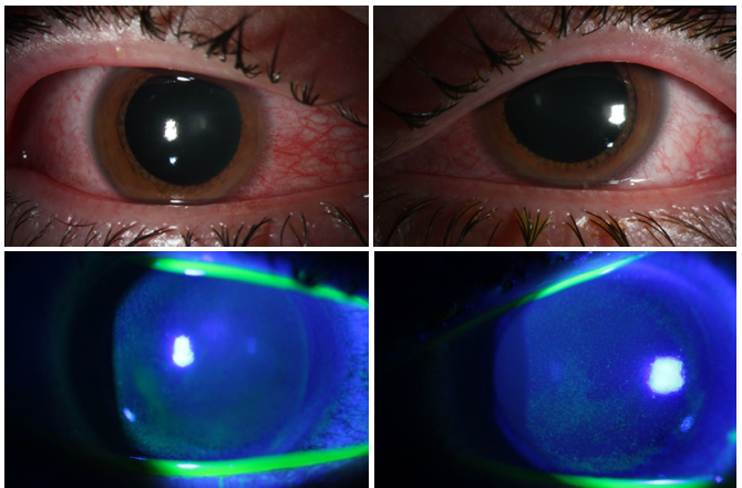 BascomPalmerEye's tweet photo. Residents Jesse Sengillo &amp; Anne Kunkler, and Dr. Guillermo Amescua presented multiple cases of UV-photokeratitis caused by increasingly popular germicidal lamps used during #COVID19. Please avoid direct exposure to UV-C lamps and follow manufacturer instructions closely if used! https://t.co/sVwejz3dCu