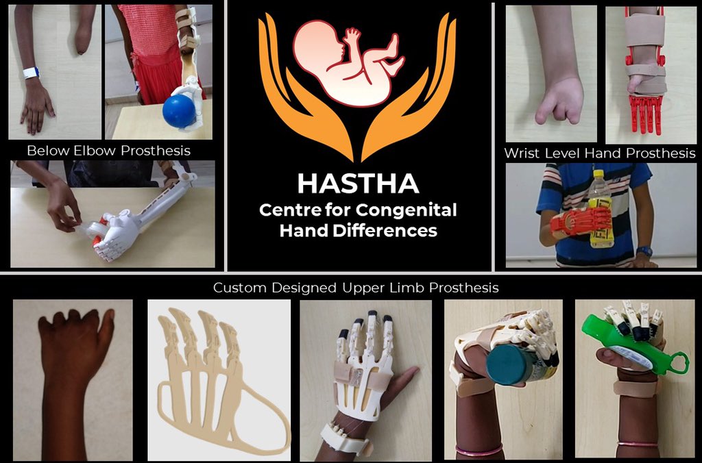 anilbhatortho's tweet photo. Our #3DProsthesis,custom made for children at #Hastha,centre for #CongenitalHandDifferences 
Bringing smiles😊back with team work@Aammaarrttyyaa @satyam0521 

@pkmadridista @VishaalBhat @KiniPushpa @itius @ChrisDyMD @Congenitalhand @OrthopodReg @OrthoFolks @zafnaqui #orthotwitter https://t.co/mDEBAev5SU