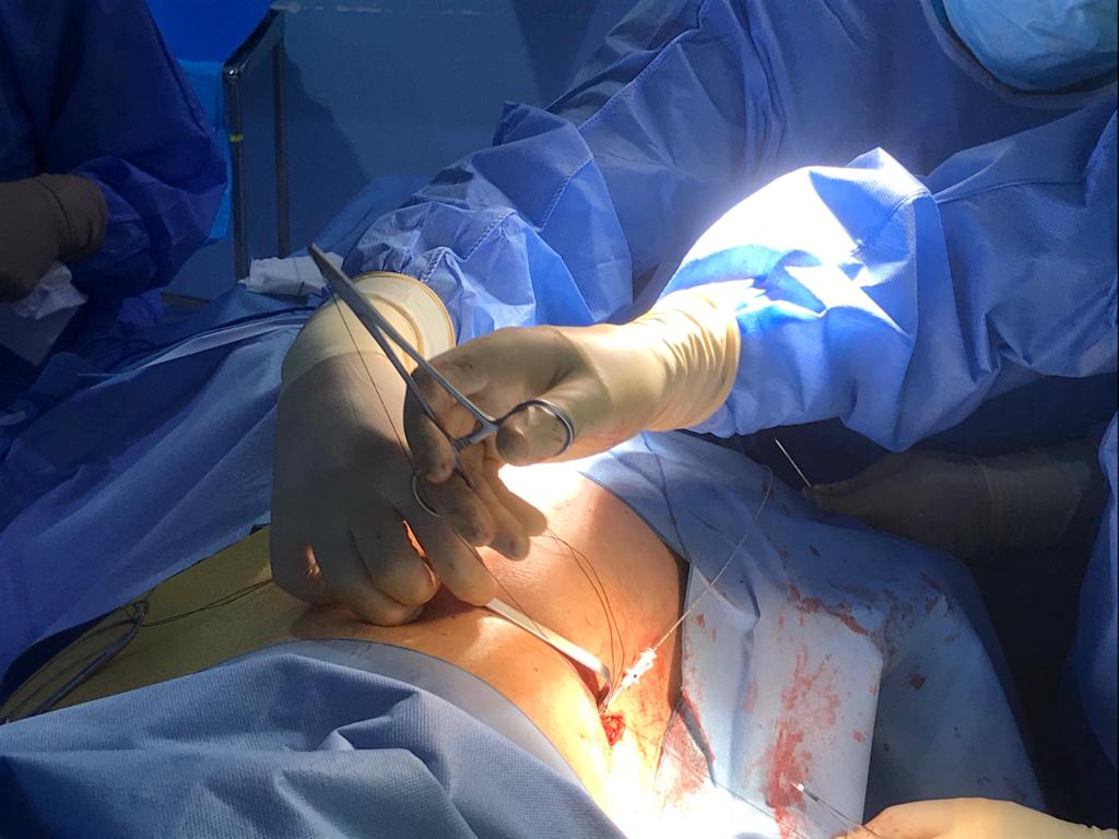 envalon's tweet photo. Tratamiento del dolor oncologico en la Unidad del Dolor de Ubeda. Bomba intratecal Syncromed. Satisfechos médicos, enfermería y paciente @bicciolo @Sedolor @Saludand_Jaen https://t.co/JMvoJl8qli