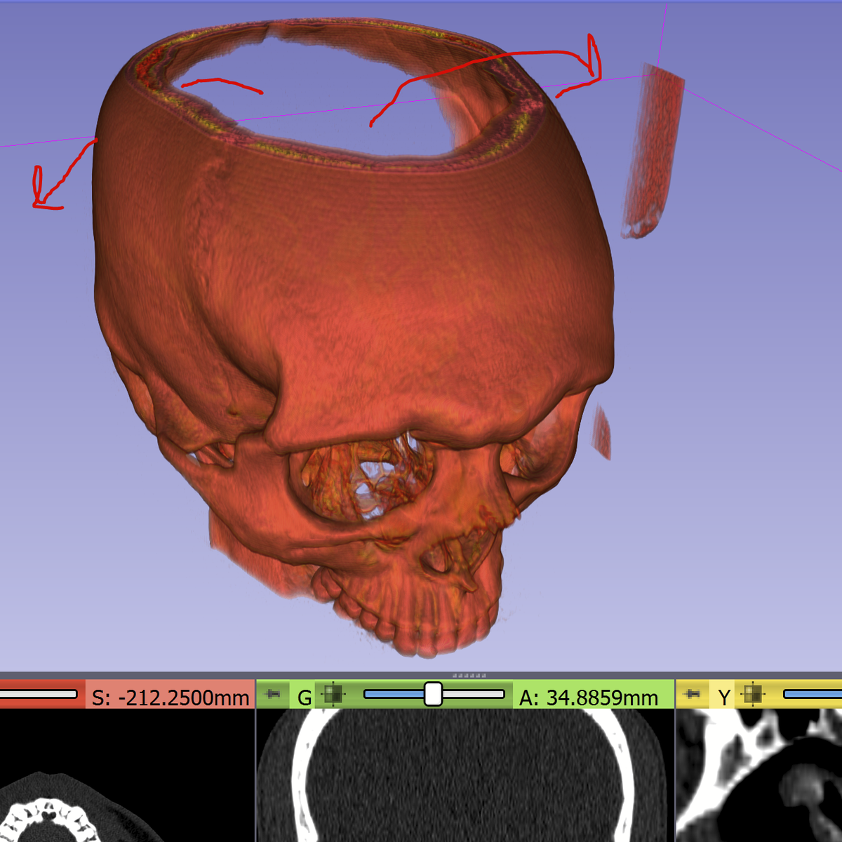 WilliamOsman's tweet photo. Quick update on my medical stuff. Doctors suspect my brain fell out of either the top hole or back hole. https://t.co/q0AAMs7RBm