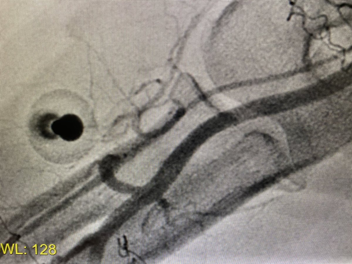 evandrofilhobr's tweet image. #ICFIT
Troubleshooting #RadialFirst approach  - cubital crossover in radial acessory anatomies