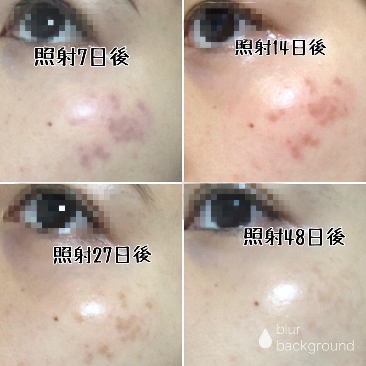 後天性真皮メラノサイトーシス 後天性真皮メラノサイトーシス