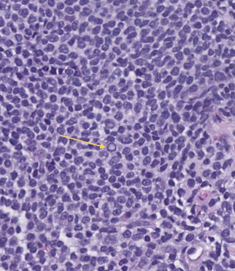 TashakoriM's tweet photo. Not the best quality (scanned slides 😒) but wanted to share a pearl from today’s #LJMFridayUnknown: 
▫️when you see Dutcher bodies in LN, think about nodal MZL or LPL !! 
#hemepath #lymphoma #pathology #PathTwitter https://t.co/rPTHzOM4j1