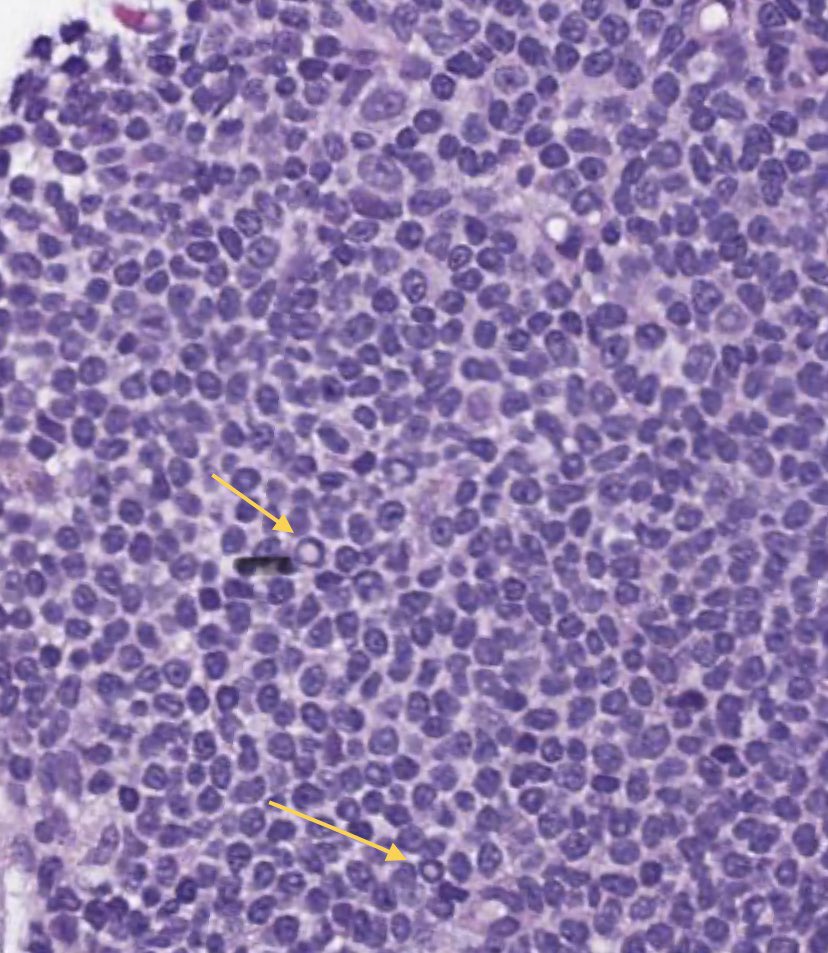 TashakoriM's tweet photo. Not the best quality (scanned slides 😒) but wanted to share a pearl from today’s #LJMFridayUnknown: 
▫️when you see Dutcher bodies in LN, think about nodal MZL or LPL !! 
#hemepath #lymphoma #pathology #PathTwitter https://t.co/rPTHzOM4j1