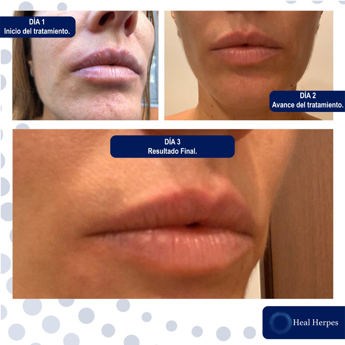 HealHerpes's tweet photo. 🍀Evolución satisfactoria de nuestros pacientes🤓,seguimos  combatiendo el herpes👊!En 3 días,sin antivirales,no invasivo, y sin riesgos colaterales,¿sientes que el aciclovir ya no tiene el mismo efecto? https://t.co/GRtMreFfDV