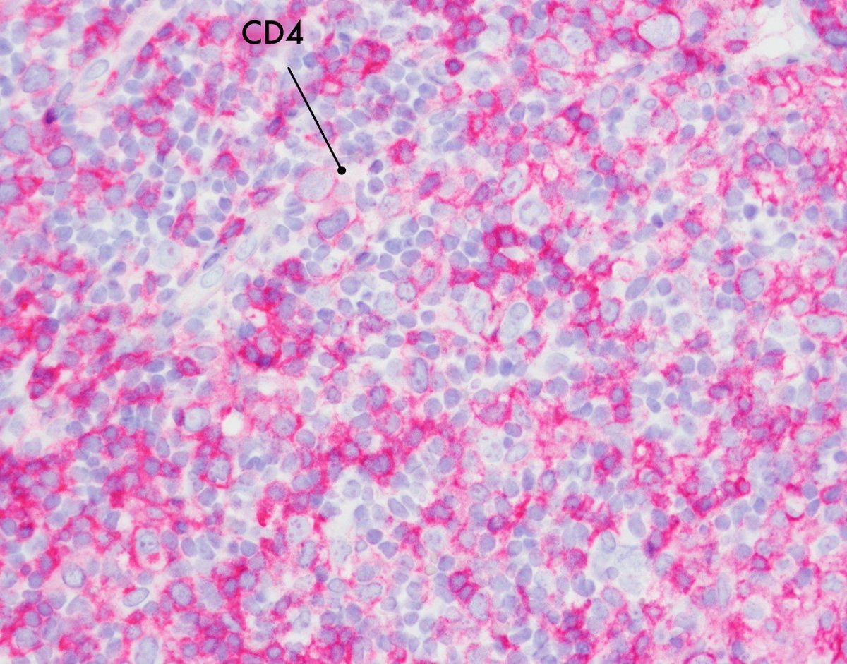 CD30+ T-cell lymphoproliferative disorder, favor lymphomatoid papulosis. Singly scattered anaplastic large cells (CD3+, CD4+, CD30+) in a polymorphous background. Requires clinical to definitively distinguish from ALCL. #hemepath #dermpath #PathTwitter