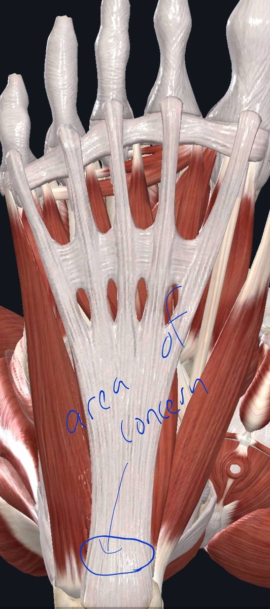 seleneparekhmd's tweet photo. The @Pacers Domantas Sabonis leaves bubble with plantar fasciitis. sometimes can have a stress response in the heel bone as well. Depending on the severity, could be gone for two to six weeks or more.@TheFantasyDRS https://t.co/3dxKvM2Zn0