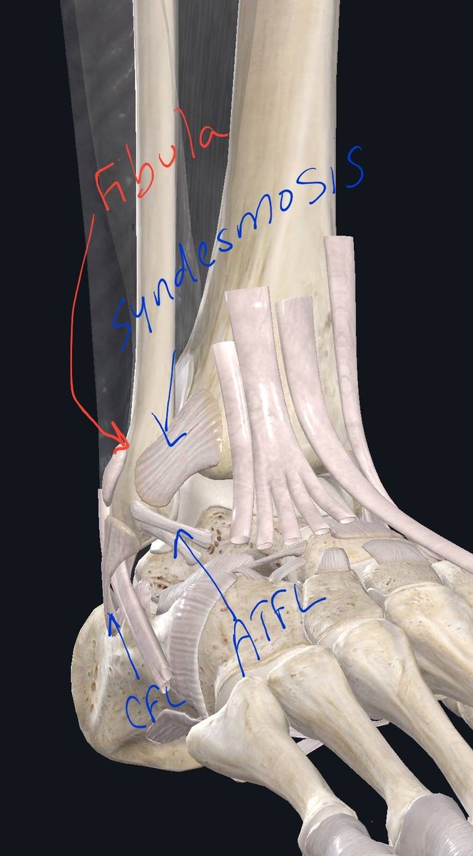 seleneparekhmd's tweet photo. The @PSG_English @KMbappe hurts ankle in a twist. Fear of a ligament injury that takes him out for the season.  Sounds like a syndesmosis injury. If unstable, surgery and out 3-6 months. If stable and just sprained 2-4 wks RTP @TheFantasyDRS https://t.co/lDS1yJ6qXv