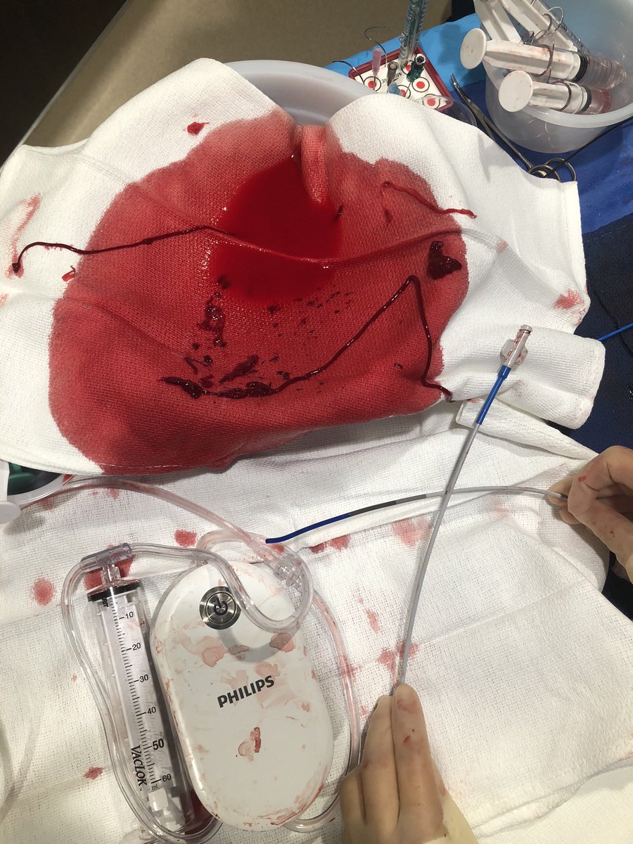 blakepparsons's tweet photo. Got to test the new @Philips #Quickclear 8F fully disposable suction thrombectomy device as first case on clotted #HeROgraft. @CarlRowe16 best quote of the day when using a new thrombectomy device “it’s going to suck either way” @JimGMelton @cvhealthclinic https://t.co/C7SzJJtzxk