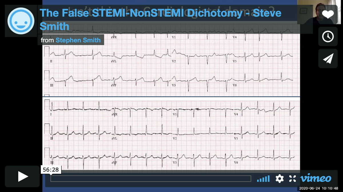 SinaiEM's tweet photo. Still relying on STEMI criteria for cath lab activation? Consider these 7 subtle ECG findings of occlusion myocardial infarction (OMI). An essential lecture for all EM residents courtesy of @smithECGBlog  https://t.co/uB68fd3cNS https://t.co/dkYetpruMh
