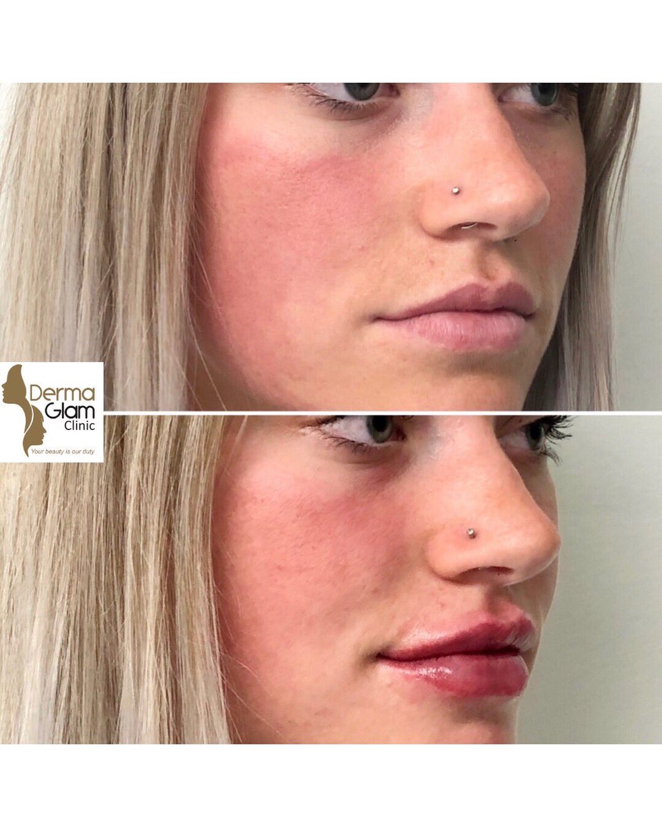 dermaglam's tweet photo. 1 ml Restylane Kysse
#torontolipfiller 
#torontolipaugmentation 
#restylanekysse https://t.co/QtzmQLVuex