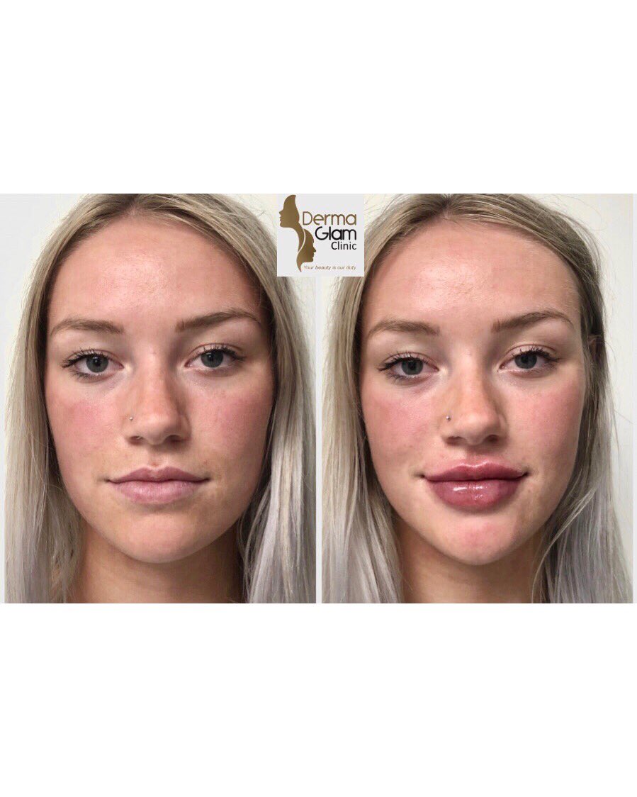 dermaglam's tweet photo. 1 ml Restylane Kysse
#torontolipfiller 
#torontolipaugmentation 
#restylanekysse https://t.co/QtzmQLVuex