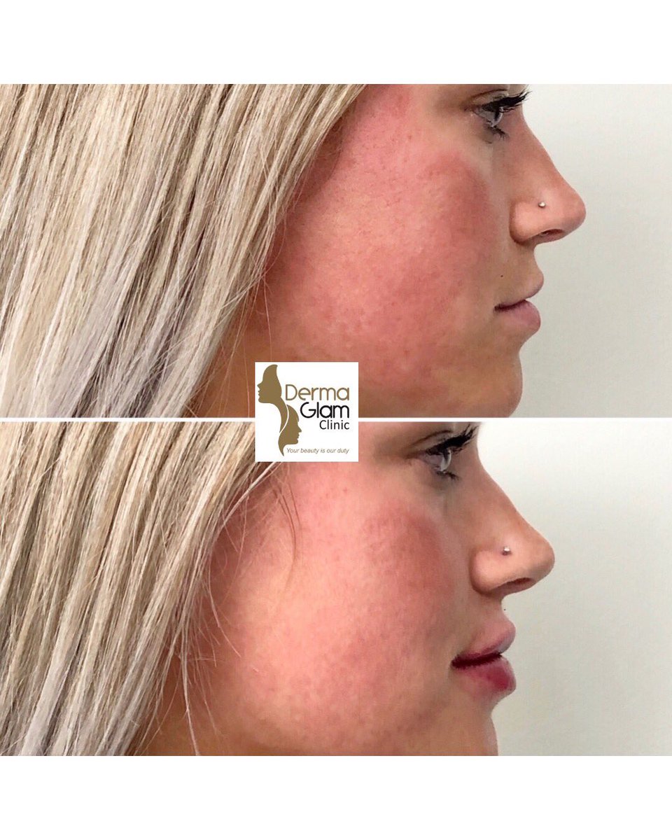 dermaglam's tweet photo. 1 ml Restylane Kysse
#torontolipfiller 
#torontolipaugmentation 
#restylanekysse https://t.co/QtzmQLVuex